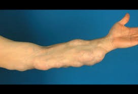 Lipoma